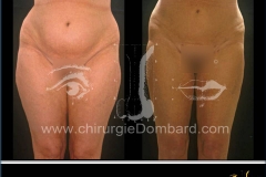 liposuccion liposculpture
