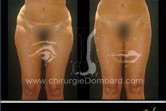 liposuccion liposculpture