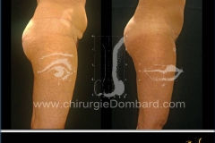 liposuccion liposculpture