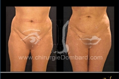 liposuccion liposculpture