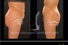 liposuccion liposculpture