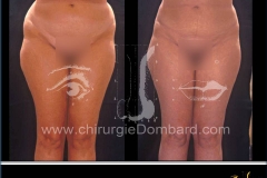 liposuccion liposculpture