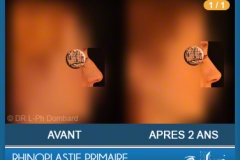Rhinoplastie Primaire - First Rhinoplasty - Neuscorrectie