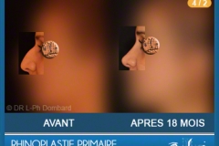 Rhinoplastie Primaire - First Rhinoplasty - Neuscorrectie