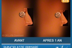 Rhinoplastie Primaire - First Rhinoplasty - Neuscorrectie