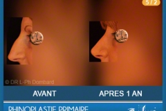 Rhinoplastie Primaire - First Rhinoplasty - Neuscorrectie