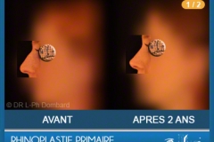 Rhinoplastie Primaire - First Rhinoplasty - Neuscorrectie