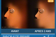 Rhinoplastie Primaire - First Rhinoplasty - Neuscorrectie