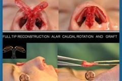 Rhinoplastie Primaire - First Rhinoplasty - Neuscorrectie