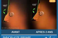 Rhinoplastie Primaire - First Rhinoplasty - Neuscorrectie