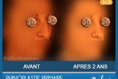 Rhinoplastie Primaire - First Rhinoplasty - Neuscorrectie