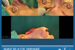 Rhinoplastie Primaire - First Rhinoplasty - Neuscorrectie