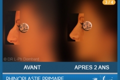 Rhinoplastie Primaire - First Rhinoplasty - Neuscorrectie