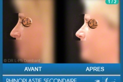 Rhinoplastie Secondaire - Rhinoplastie ratée - Rhinoplasty - Neuscorrectie