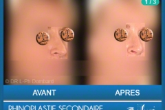 Rhinoplastie Secondaire - Rhinoplastie ratée - Rhinoplasty - Neuscorrectie