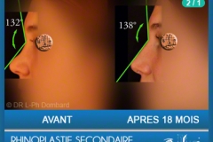 Rhinoplastie Secondaire - Rhinoplastie ratée - Rhinoplasty - Neuscorrectie