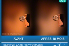 Rhinoplastie Secondaire - Rhinoplastie ratée - Rhinoplasty - Neuscorrectie