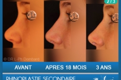 Rhinoplastie Secondaire - Rhinoplasty - Neuscorrectie