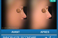 Rhinoplastie Secondaire - Rhinoplastie ratée - Rhinoplasty - Neuscorrectie