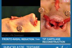 Rhinoplastie Tertiaire - Rhinoplastie ratée - Rhinoplasty - Neuscorrectie