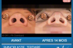 Rhinoplastie Tertiaire - Rhinoplastie ratée - Rhinoplasty - Neuscorrectie