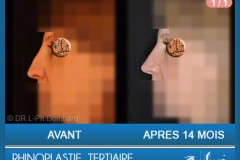 Rhinoplastie Tertiaire - Rhinoplastie ratée - Rhinoplasty - Neuscorrectie