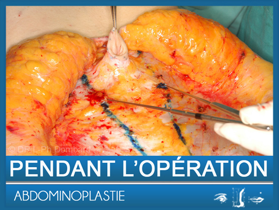 Abdominoplastie - Specialiste chirurgien esthetique DR Dombard Overijse Bruxelles