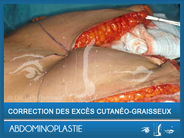 Abdominoplastie