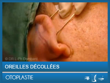 Otoplastie - Oreilles décollées