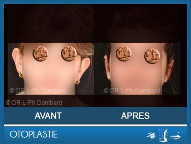 Otoplastie - Correction des oreilles décollées. Vu de face.