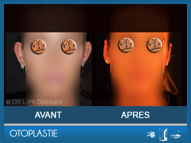 Otoplastie - Correction des oreilles décollées. Vu de face.