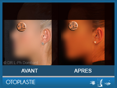 Otoplastie - Correction des oreilles décollées. Vu de profil. 