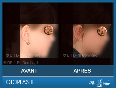 Otoplastie - Correction des oreilles décollées. Vu de profil.