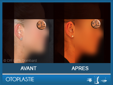 Otoplastie - Correction des oreilles décollées. Vu de profil. 