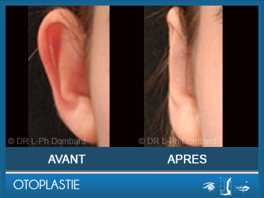 Otoplastie - correction oreilles décollées.