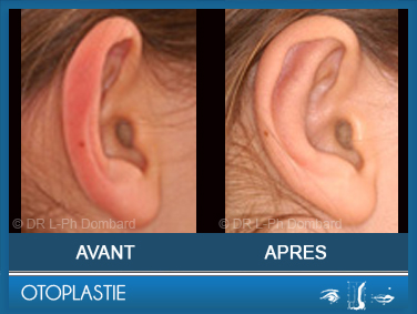 Otoplastie - correction oreilles décollées.