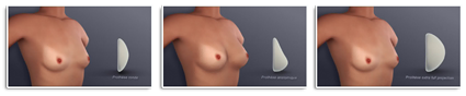 Augmentation mammaire. Prothèses mammaires les différentes formes.