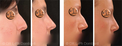 Rhinoplatie prix - chirurgie du nez Prix