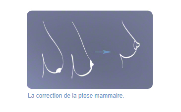 Ptose mammaire - Chirurgie esthetique DR Dombard