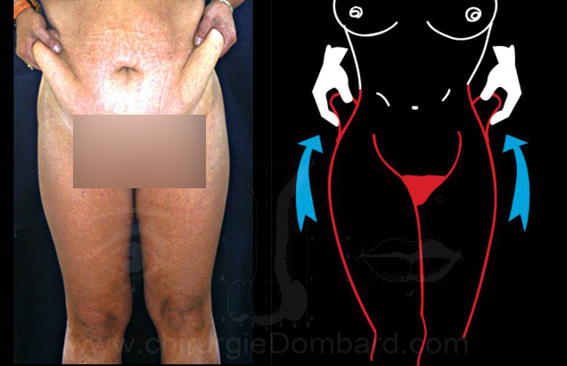 Flancoplastie - DR Dombard