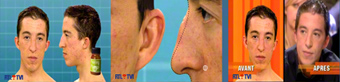 Peeling chirurgie du visage - Otoplastie chirurgie des oreilles décollées - Rhinoplastie Neuscorrectie chirurgie du nez Belgique DR Dombard