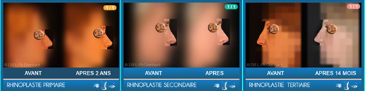 Rhinoplastie Primaire - Rhinoplastie Secondaire - Rhinoplastie Tertiaire