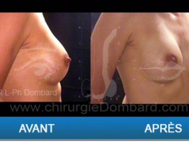 Chirurgie mammaire chirurgie des seins Ptose mammaire varia - DR Dombard Bruxelles - Belgique