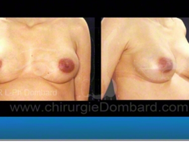 Examen de routine: Femme enceinte avec implants.