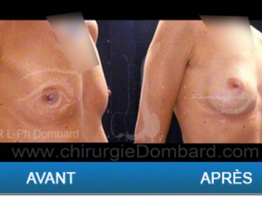 Chirurgie mammaire chirurgie des seins Ptose mammaire varia - DR Dombard Bruxelles - Belgique