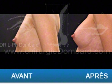 Chirurgie mammaire chirurgie des seins Ptose mammaire varia - DR Dombard Bruxelles - Belgique