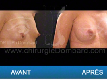 Chirurgie mammaire chirurgie des seins Ptose mammaire varia - DR Dombard Bruxelles - Belgique