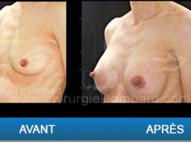 Chirurgie mammaire chirurgie des seins Ptose mammaire varia - DR Dombard Bruxelles - Belgique