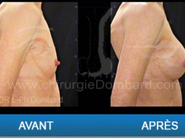 Chirurgie mammaire chirurgie des seins Ptose mammaire varia - DR Dombard Bruxelles - Belgique
