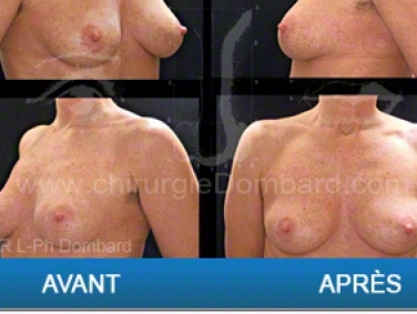 Chirurgie mammaire chirurgie des seins Ptose mammaire varia - DR Dombard Bruxelles - Belgique